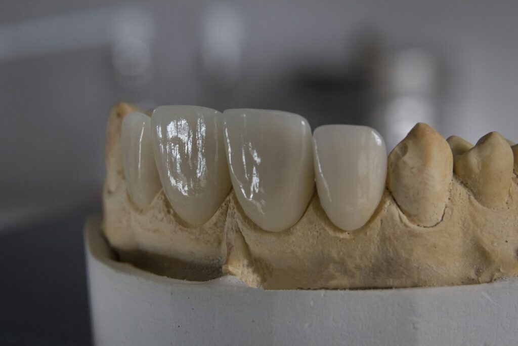 Dental crowns on a model
