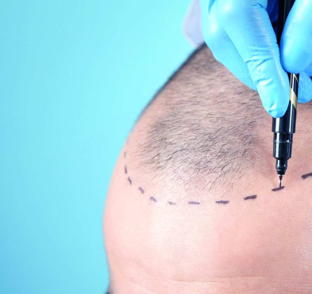 Doctor marking the hairline before hair transplantation