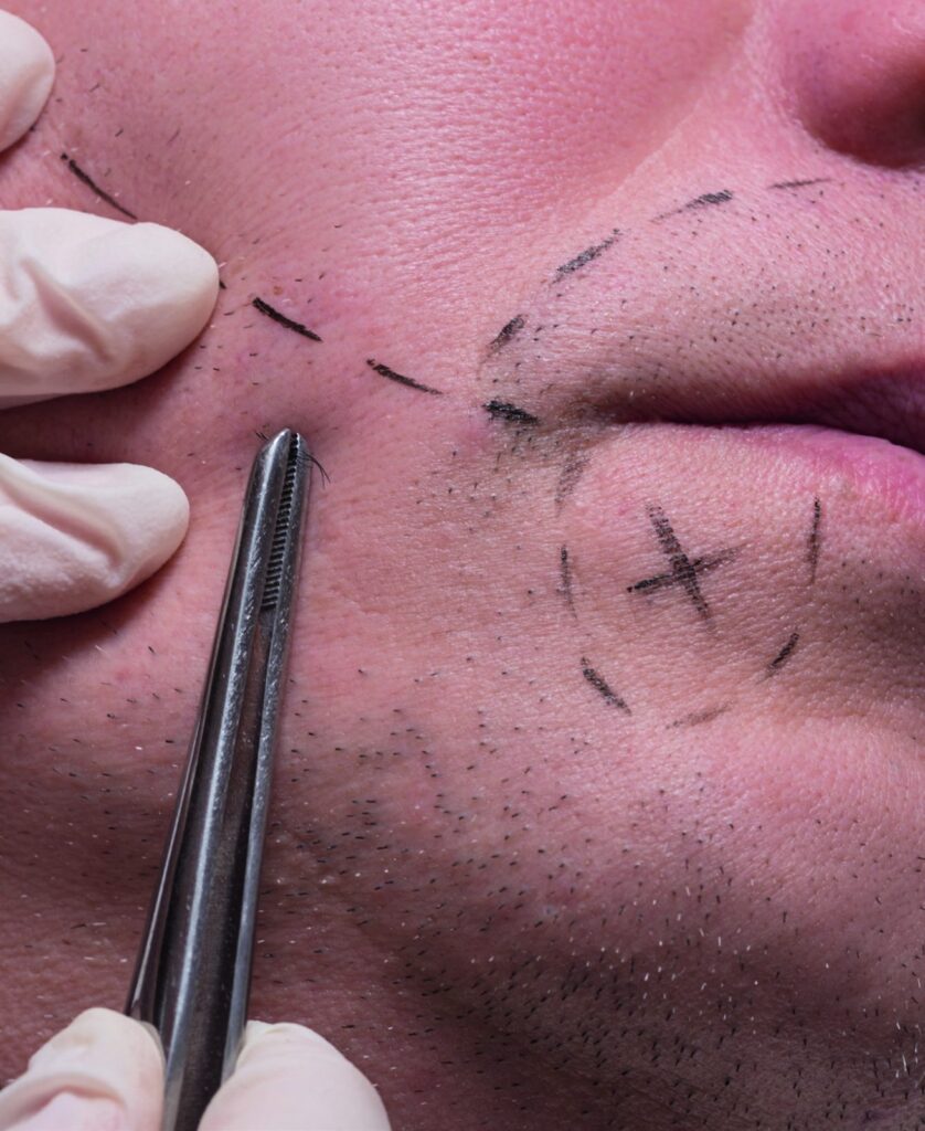 Beard transplant planning with marked areas on the cheek