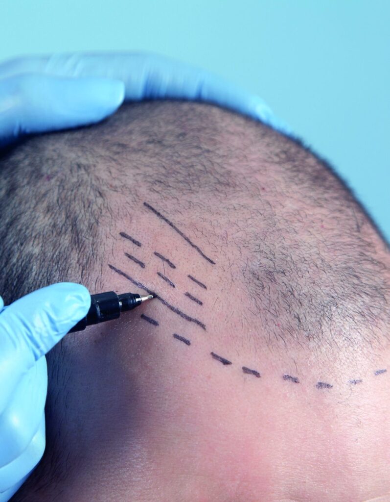 Hairline planning for an FUE hair transplant