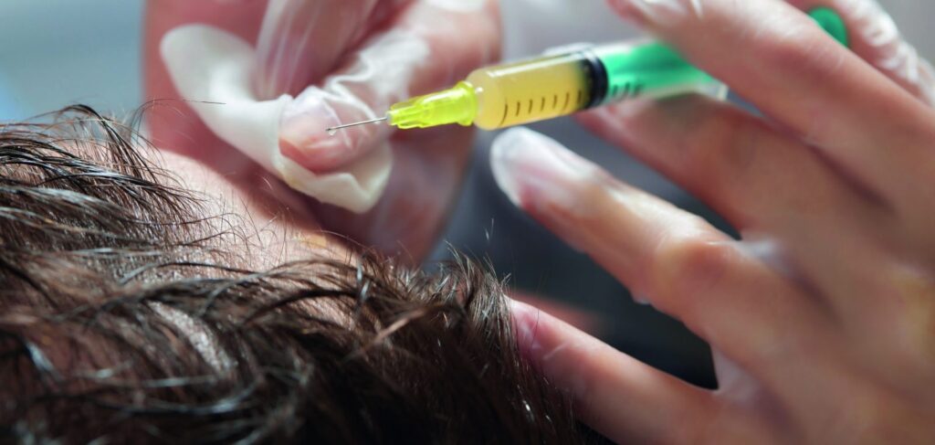Mesotherapy injection into the scalp for hair revitalisation