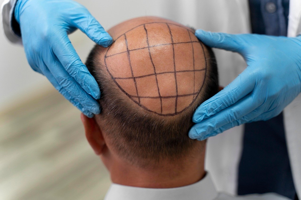Hair transplant planning with the treatment area marked on the scalp