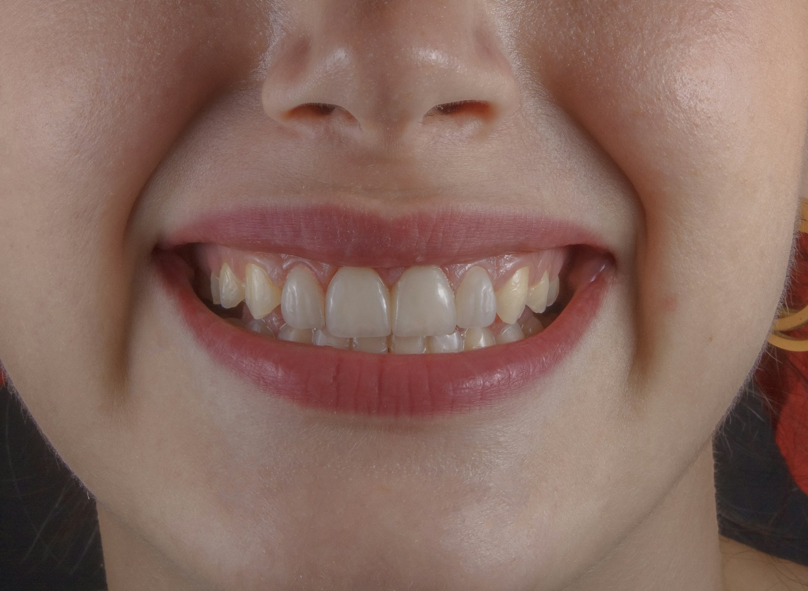 Bright, natural smile