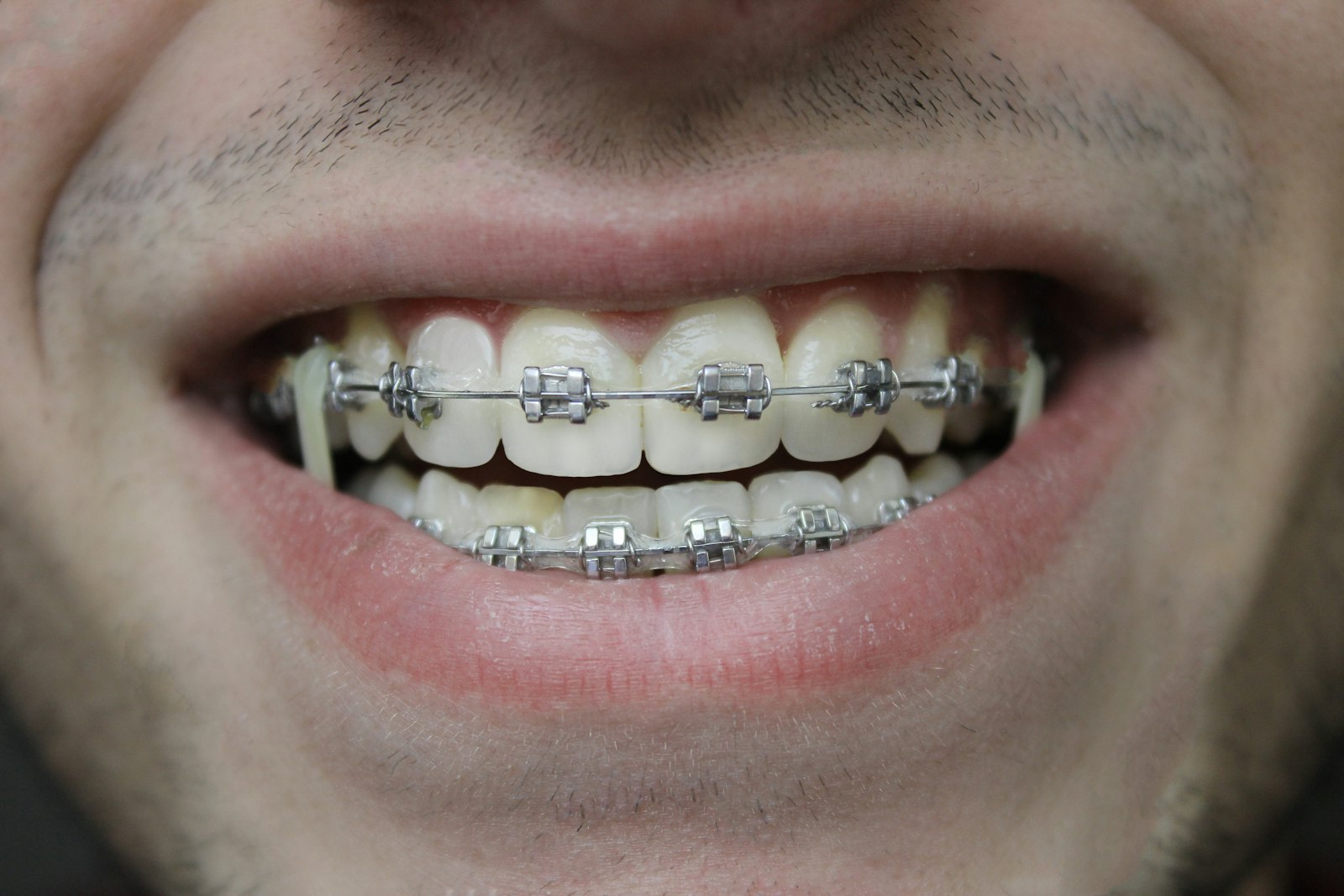 Smile with dental braces