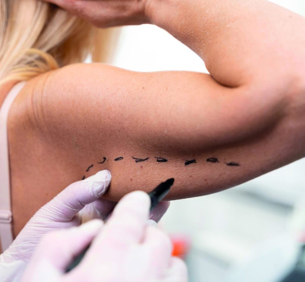 Upper arm marked for brachioplasty
