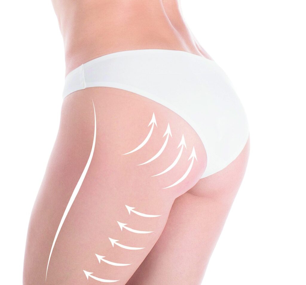 Buttock contouring illustration