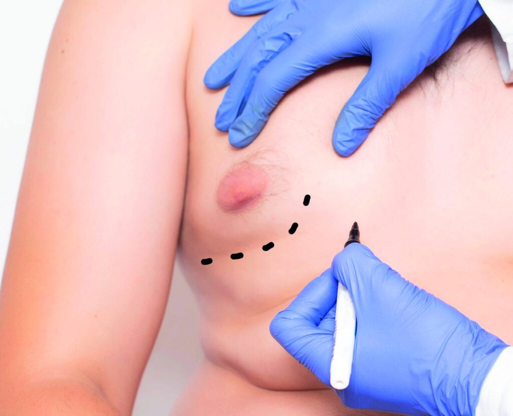 Chest marking before gynecomastia surgery