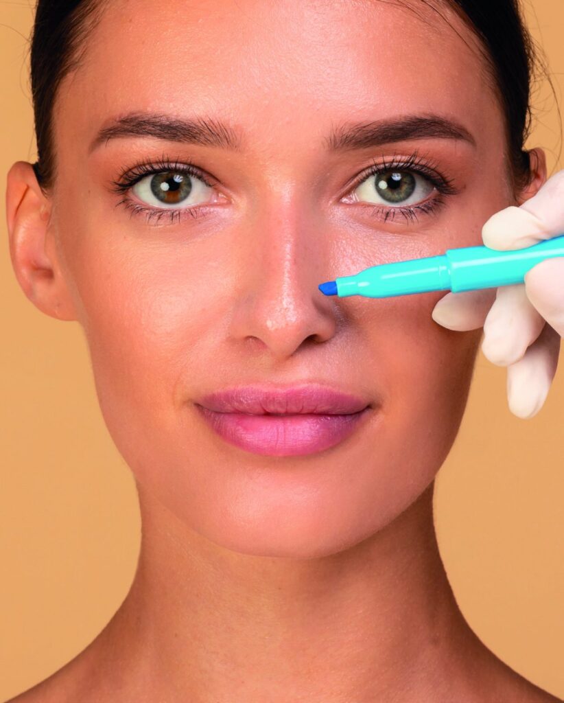 Nose marked for rhinoplasty planning